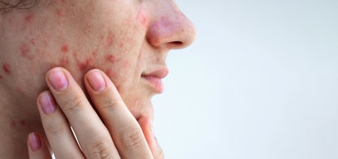acne-is-not-just-a-problem-for-teenagers