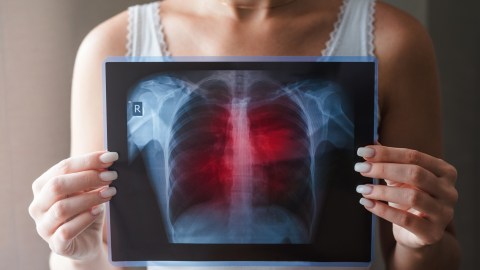 lung-cancer,-an-ignored-problem:-most-of-those-who-should-undergo-screening-tests-do-not-do-so