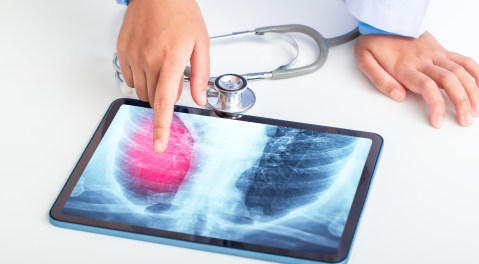 advances-in-diagnosis:-a-tuberculosis-test-is-born-that-does-not-need-phlegm