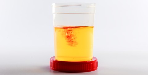 blood-in-the-urine,-the-predominant-symptom-of-bladder-cancer