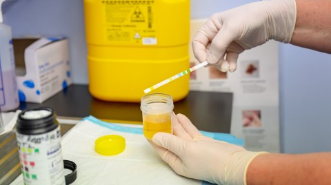 revolutionary-advance-in-the-diagnosis-of-prostate-cancer:-new-urine-test-improves-patient-follow-up