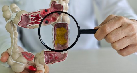 impact-of-inflammatory-bowel-disease:-the-importance-of-early-detection